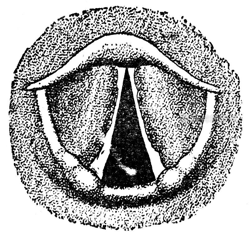 19世纪伴有声带炎的喉镜观察