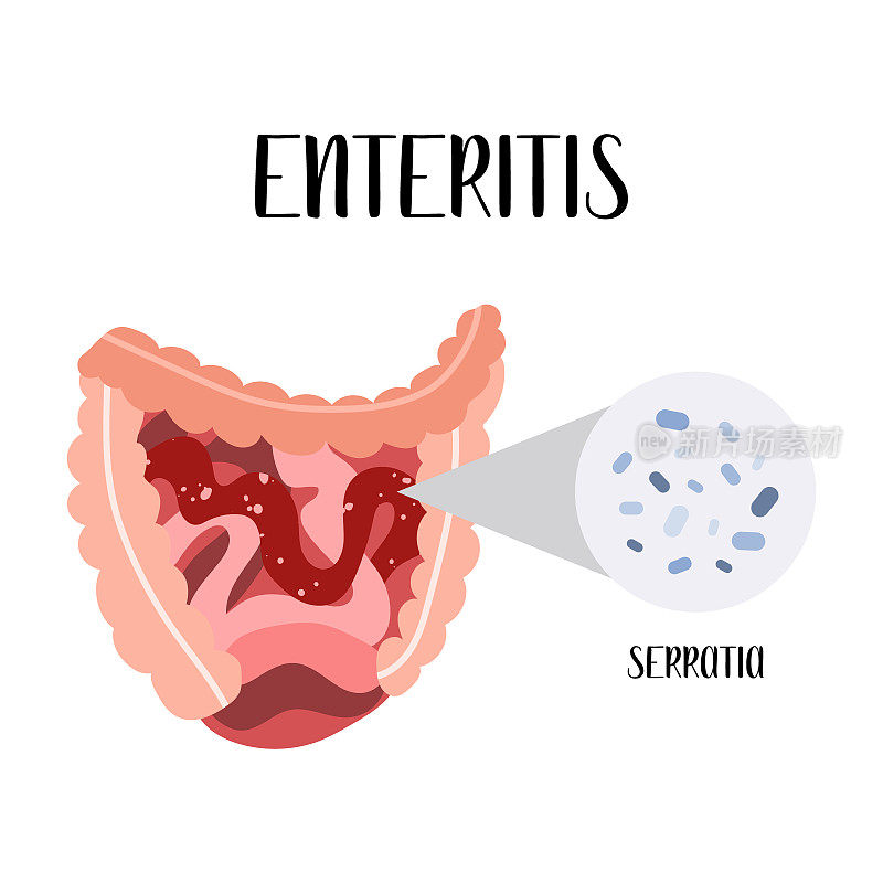 肠炎，小肠的炎症。沙雷氏菌属的细菌。肠道疾病。胃肠病学。矢量平面插图。完美的传单，医疗宣传册，横幅，登陆页面，网站