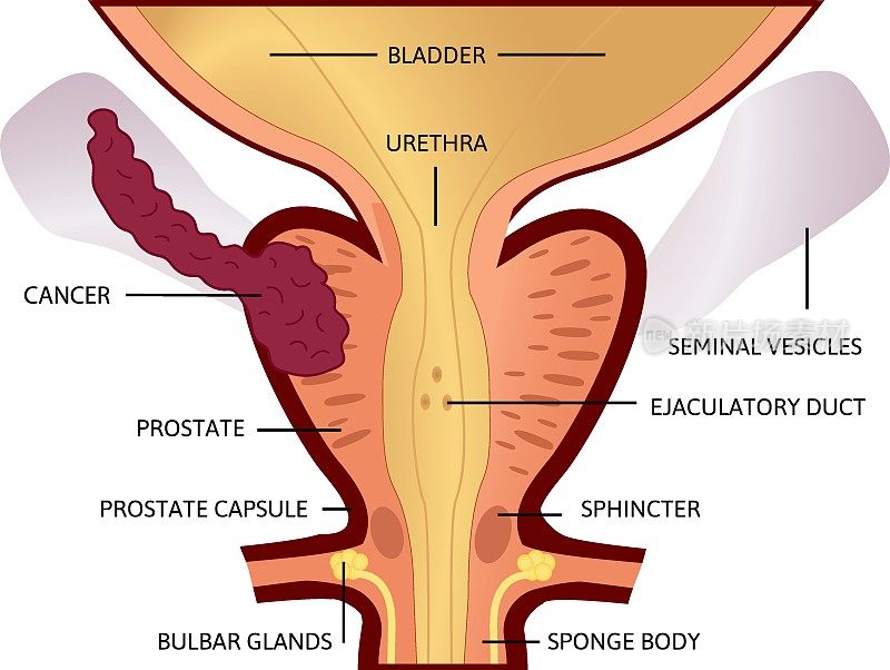 前列腺癌的第三阶段。肿瘤体积大，位于前列腺，发展成精囊。