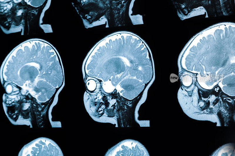婴儿脑部MRi显示脑白质病变和发育异常