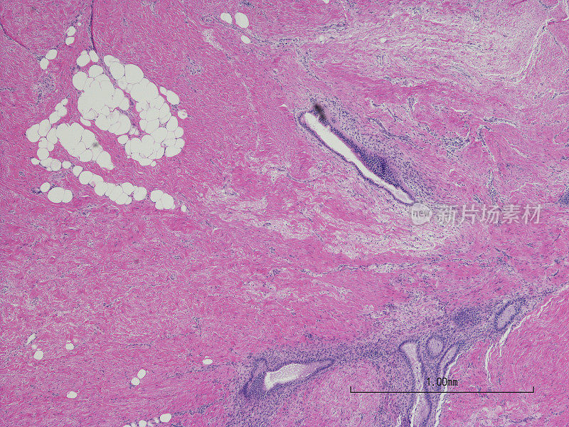 腹壁子宫内膜异位症。剖腹产疤痕