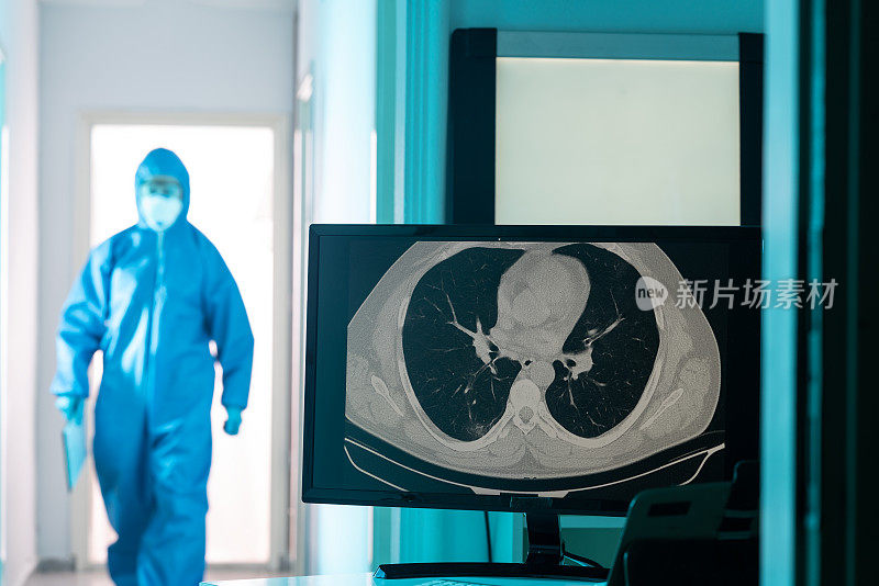放射科门诊电脑显示器上冠状病毒阳性患者胸部CT图像