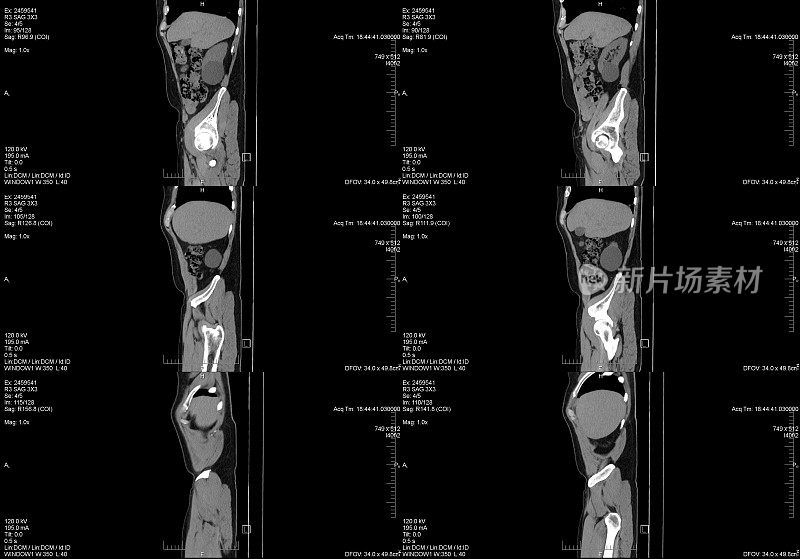 腹部骨盆Cat扫描侧视图带注释
