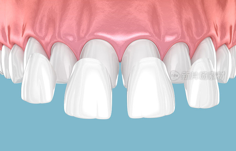牙齿贴面放置在门牙上。三维演示