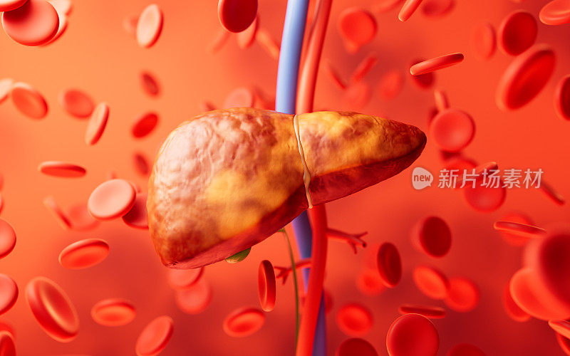 肝脏器官与脂肪肝状态，3d渲染。
