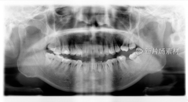 成人牙齿和牙龈x光片