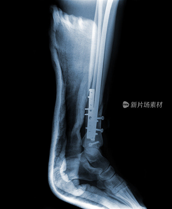 下肢骨折x线照片