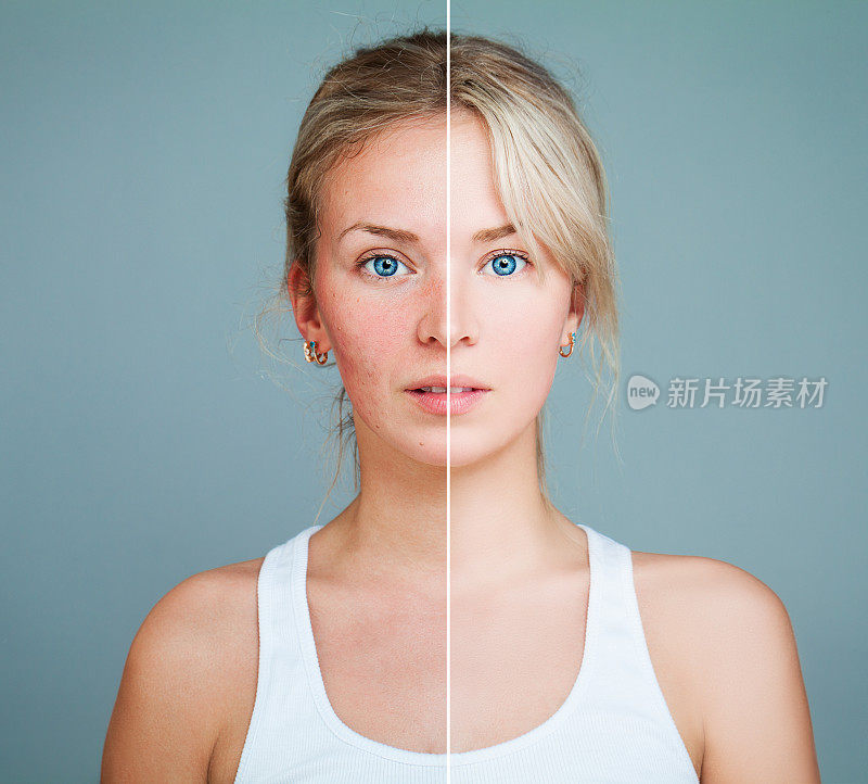 有皮肤问题的年轻模特。女性脸分为健康和不健康两部分。面部治疗，医学和美容概念