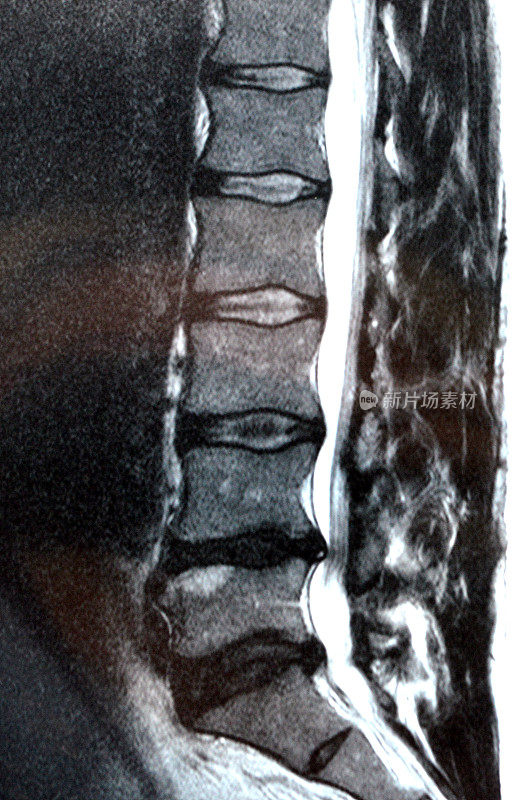 脊柱MRI扫描显示椎间盘突出