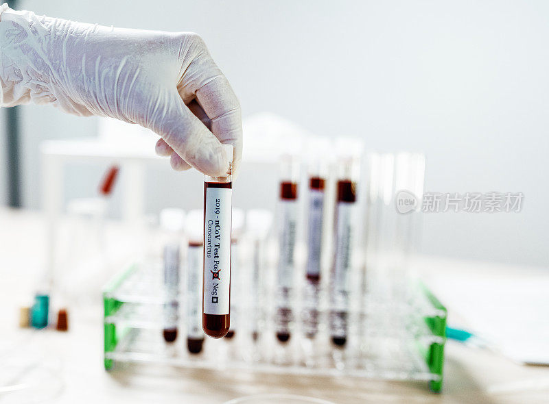 COVID-19阳性检测-血液样本的实验室检查