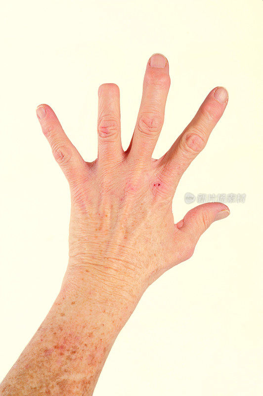 手指截肢和关节炎