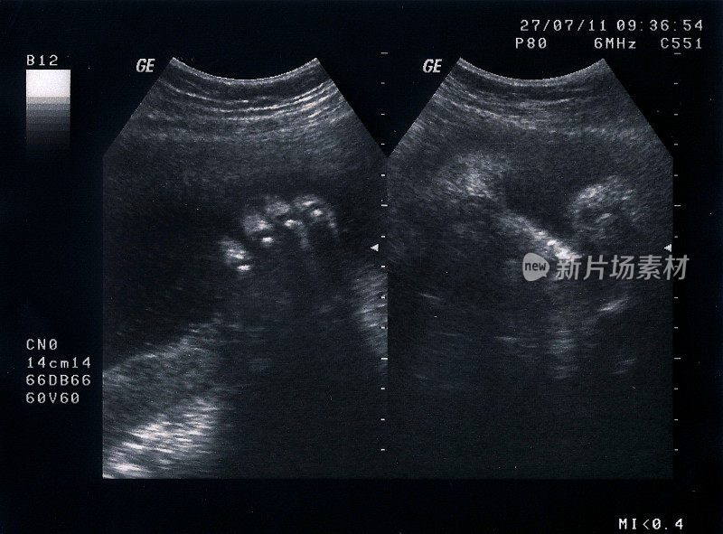 胎儿超声波检查，35周