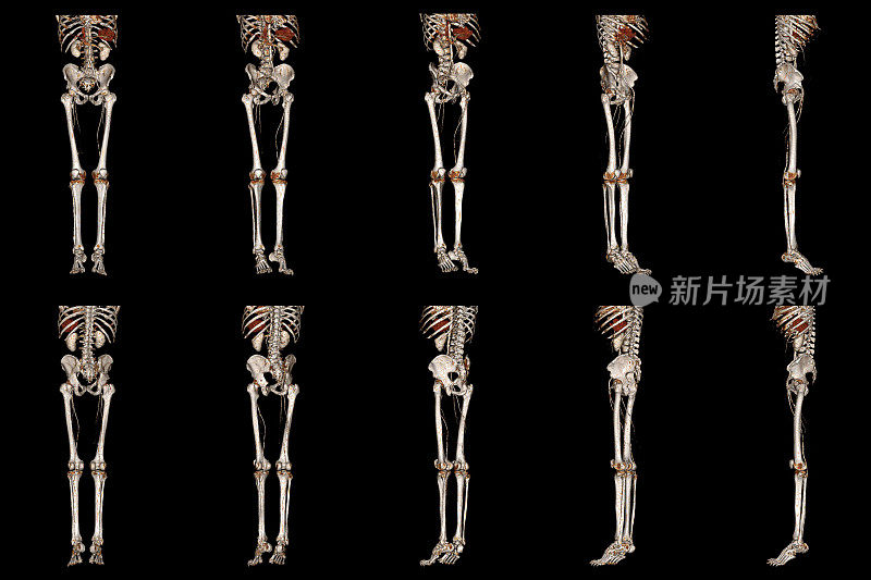 多探头CT下肢血管造影