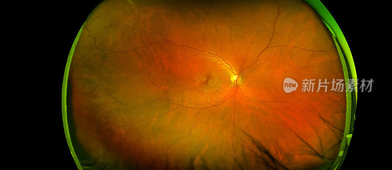 伴有黄斑、血管和视盘的视网膜角度图像