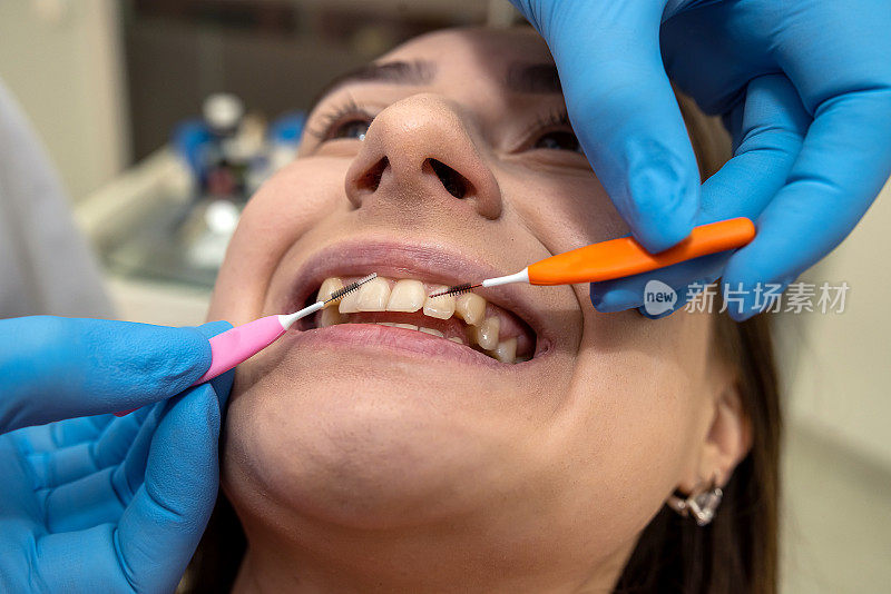 牙医在诊所使用近端牙间刷来清洁牙齿