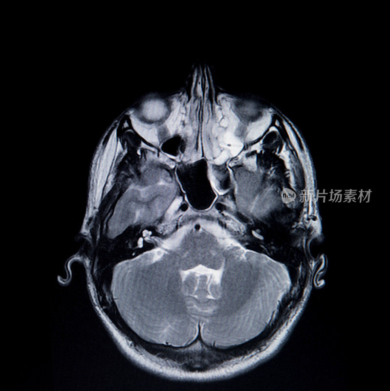 核磁共振大脑扫描