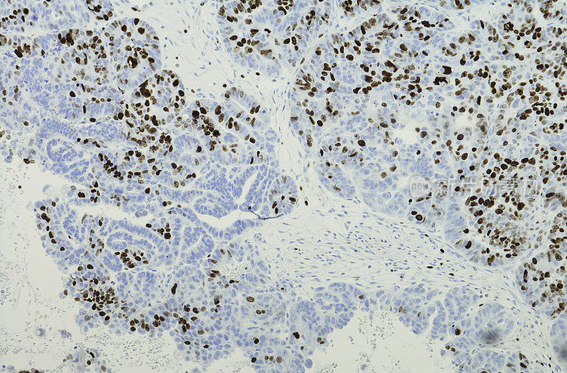 子宫内膜浆液性乳头状癌Ki67免疫染色。