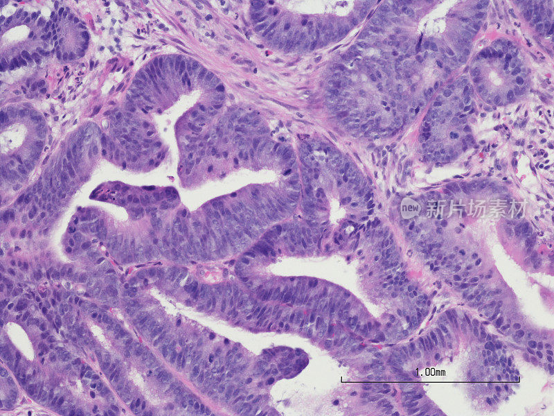 结肠腺癌H&E染色
