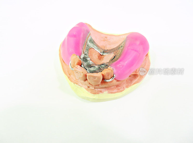 牙科局部义齿