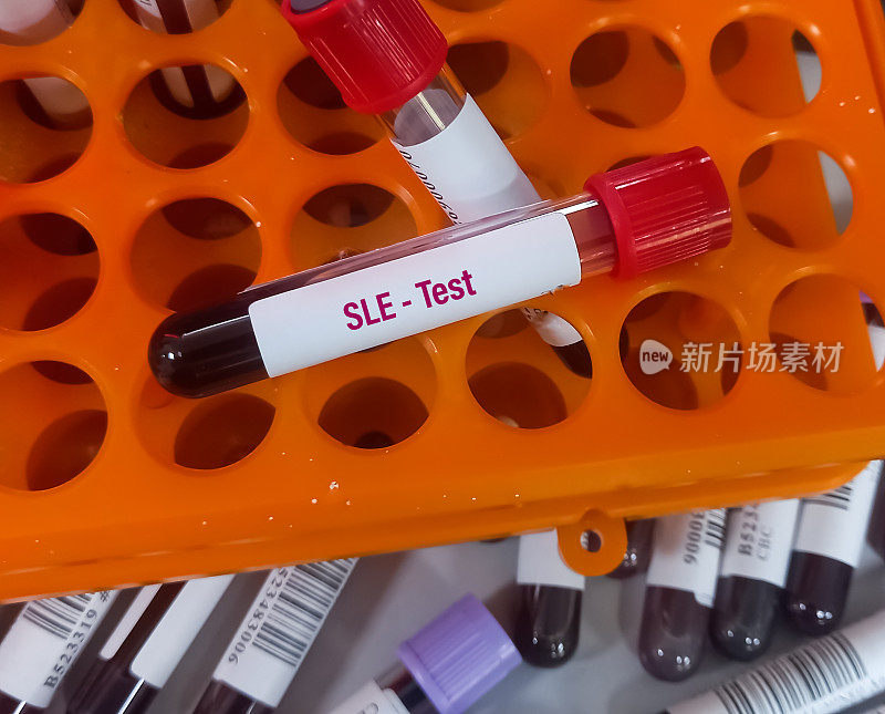 血液样本用于系统性红斑狼疮(SLE)检测诊断自身免疫性疾病。