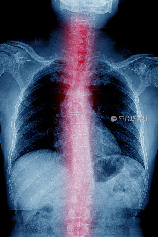 暗背景胸腰椎x线片。