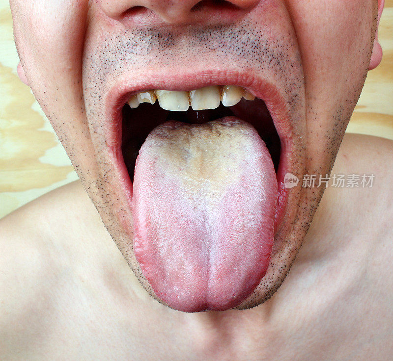 感染的舌头