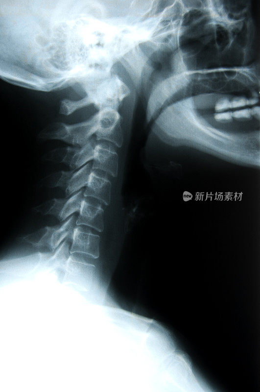 一个人的颈部和头骨的x光片
