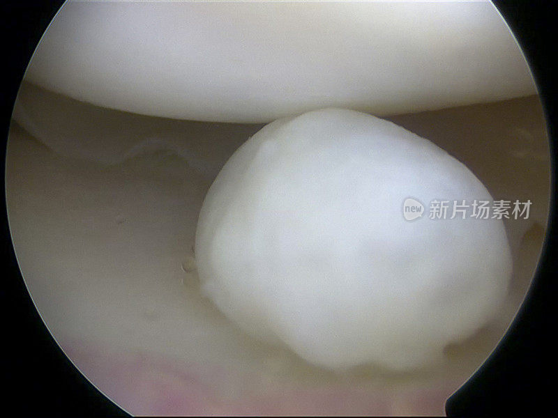 膝关节内侧腔室游离体的关节镜视图