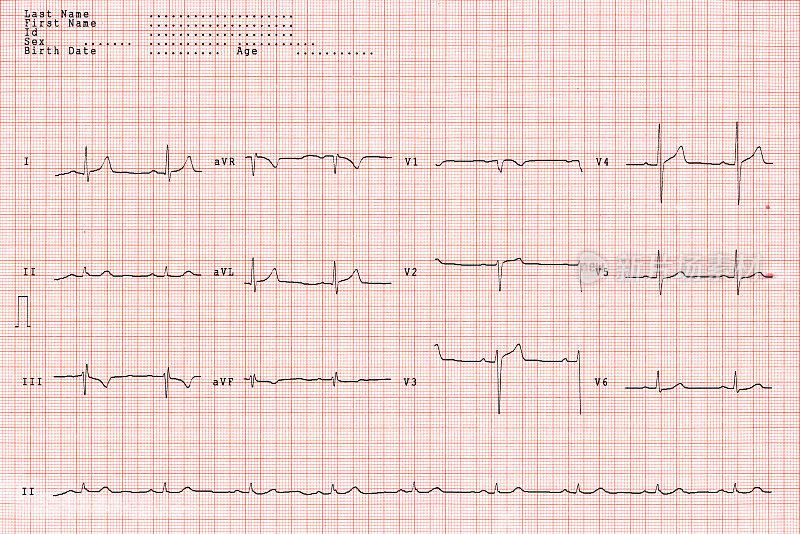 在XL急诊室拍的心电图