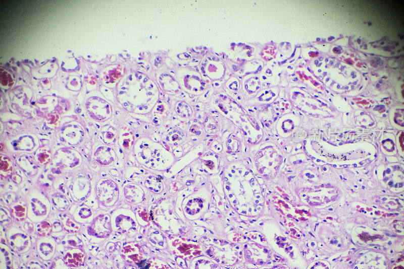 显微镜下急性肾炎活检标本