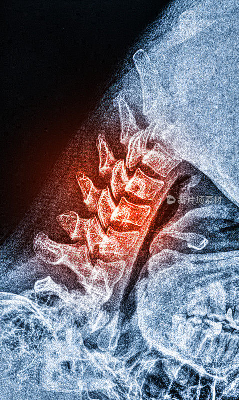对受伤颈部的x光扫描