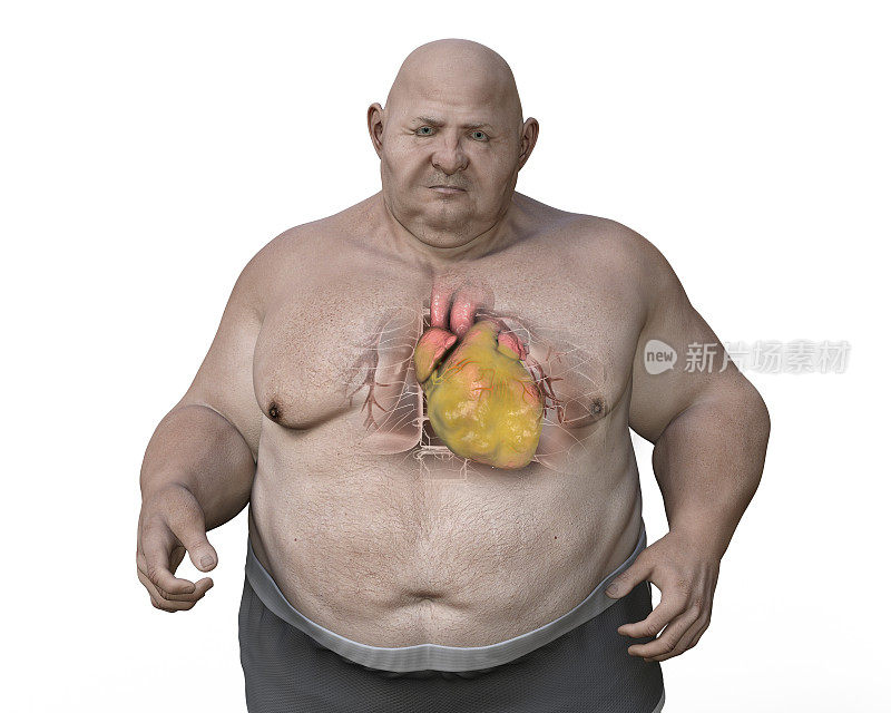 超重男性的肥胖心脏，3D插图。肥胖与内脏疾病的概念