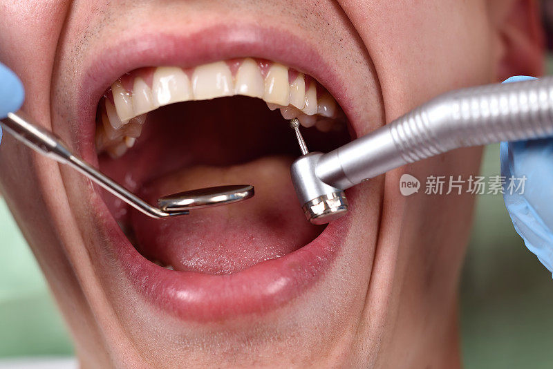 牙医使用牙钻