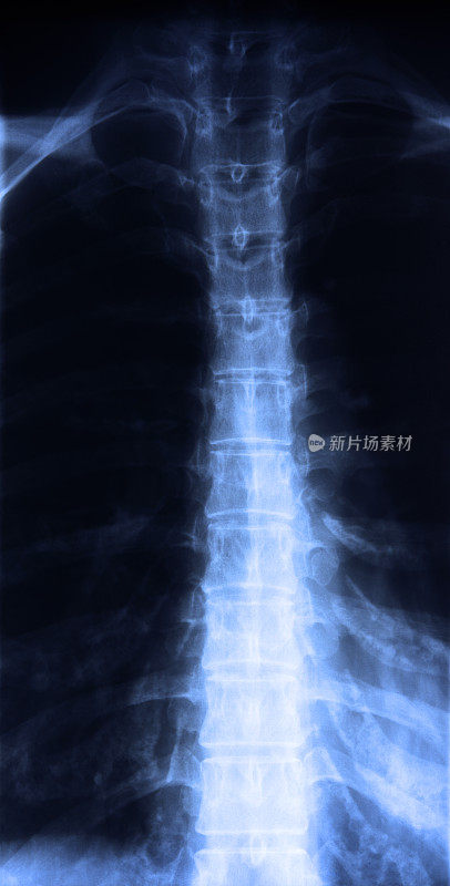 脊髓的x光片