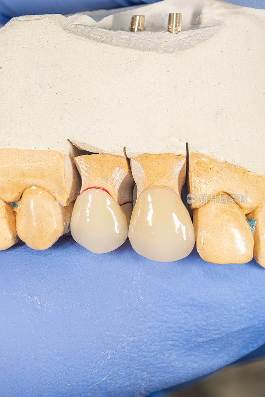 特写陶瓷牙冠在石膏模型的牙齿在牙医的手。牙科技师的工作