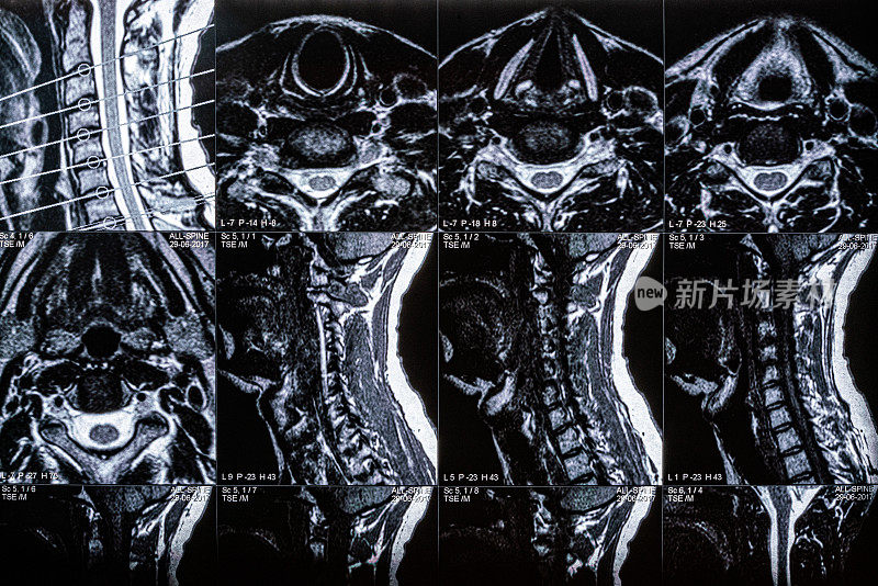 人脊柱和脊椎的MRI扫描