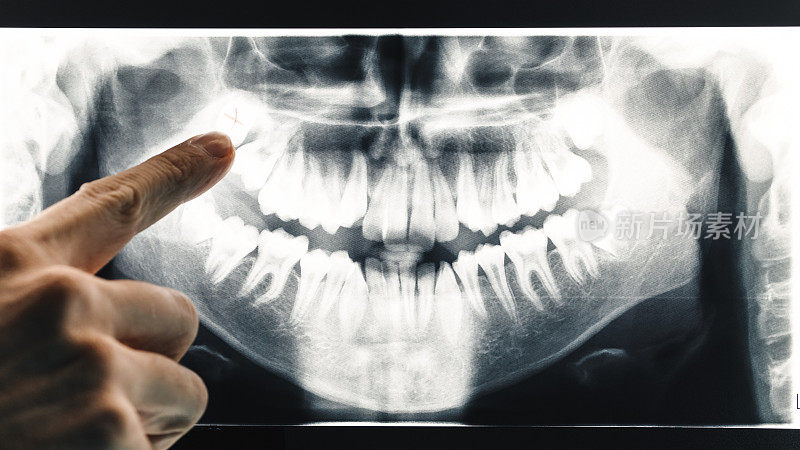 牙医用手指着x光片上的牙齿