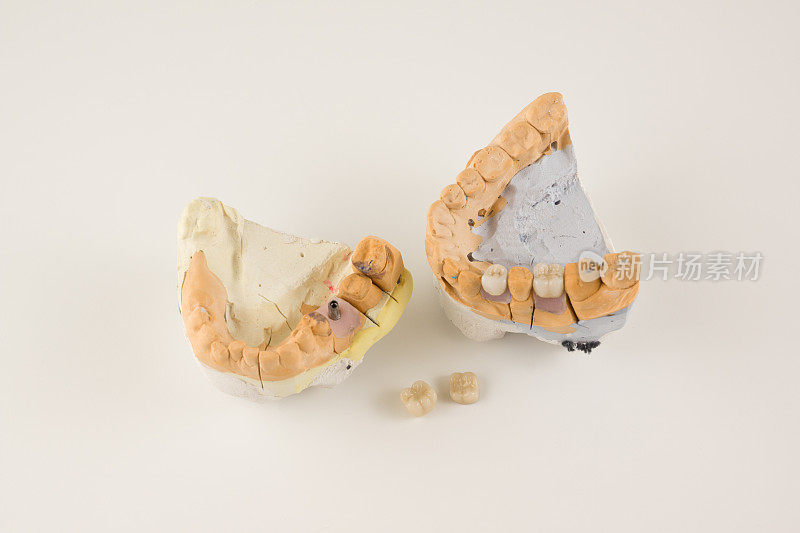 牙科修复体制作步骤