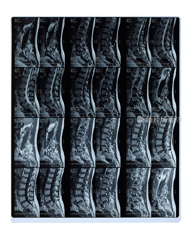 腰椎MRI扫描