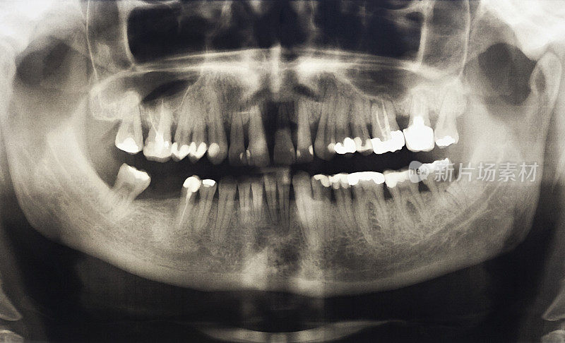 丙烯酸义齿-全前置
