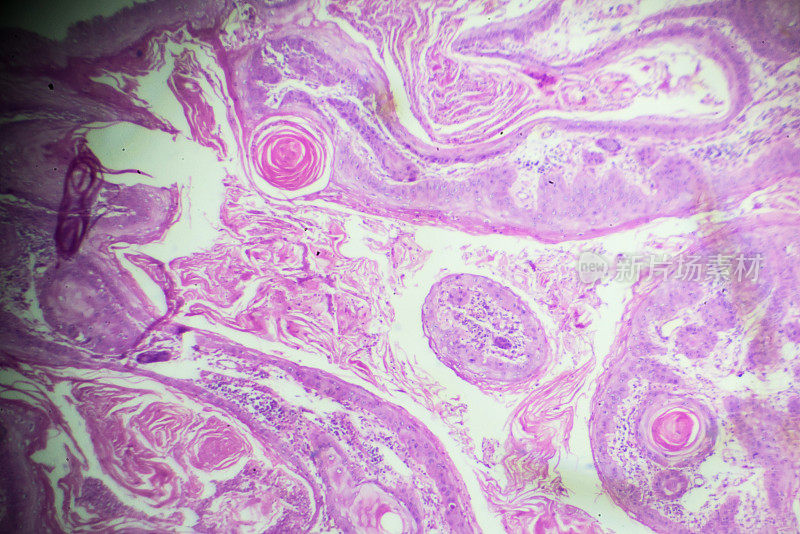 鳞状细胞癌显微镜下