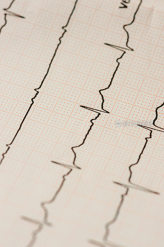 图表心电图(ECG)