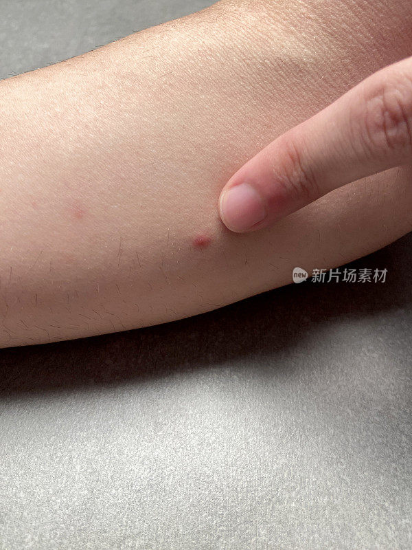 手臂上有荨麻疹。一个人的手在手臂上显示过敏