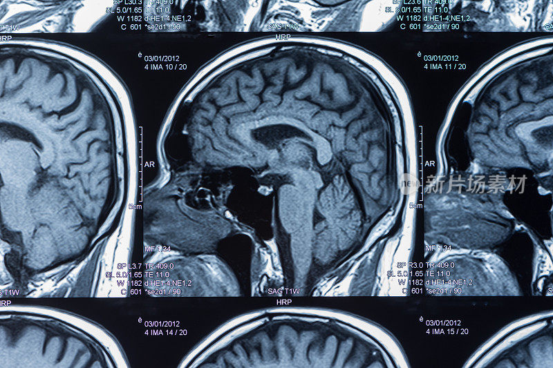 脑部核磁共振成像扫描