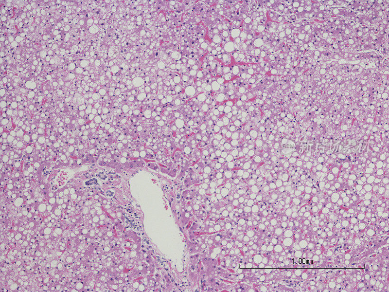 肝小泡性脂肪变性(脂肪性肝病)，