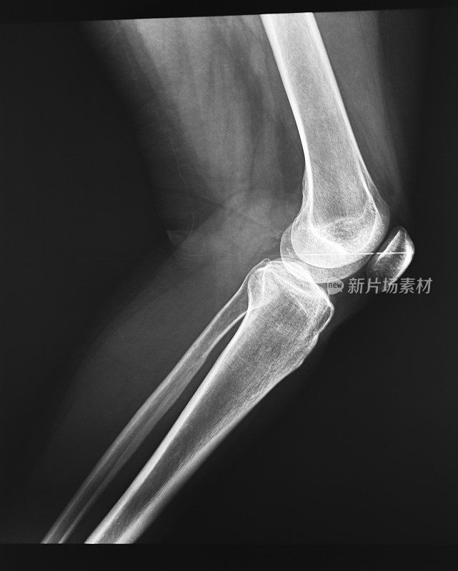 X光图像-女人的膝盖
