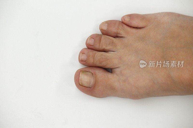趾甲病患者的趾甲过大，趾甲病是一种真菌感染，会导致趾甲变黄