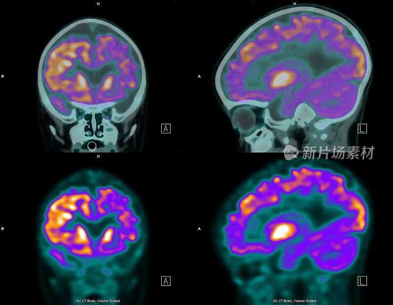 PET(正电子发射断层扫描)对大脑的扫描