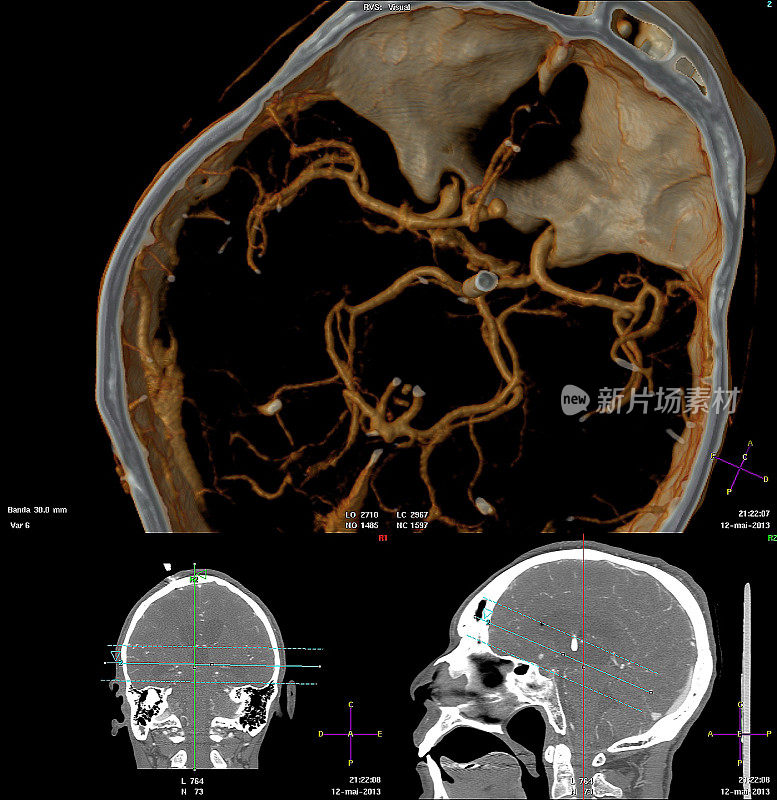 3D计算机断层扫描脑部血管造影