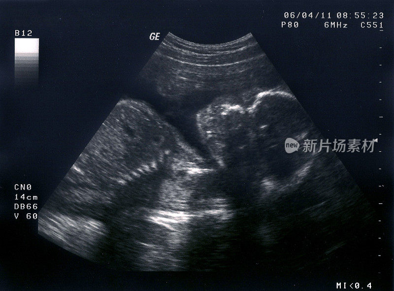 胎儿的超声波检查，16周